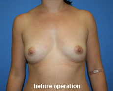 plastic-surgery-breast-augmentation